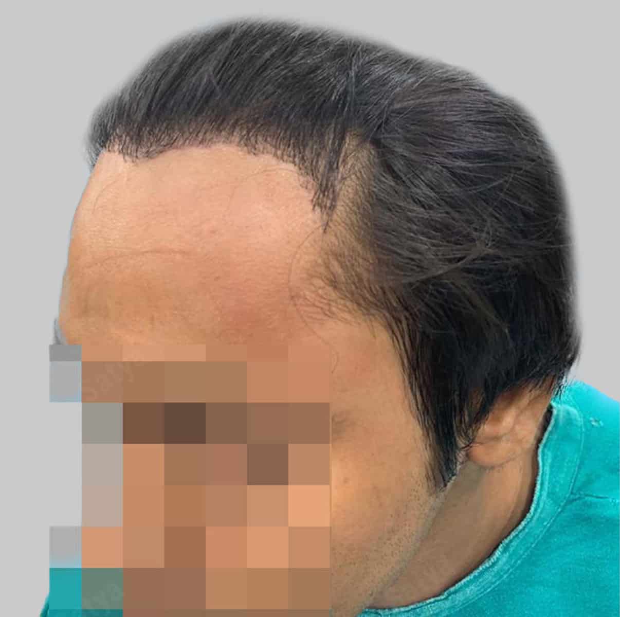 repair hair transplant