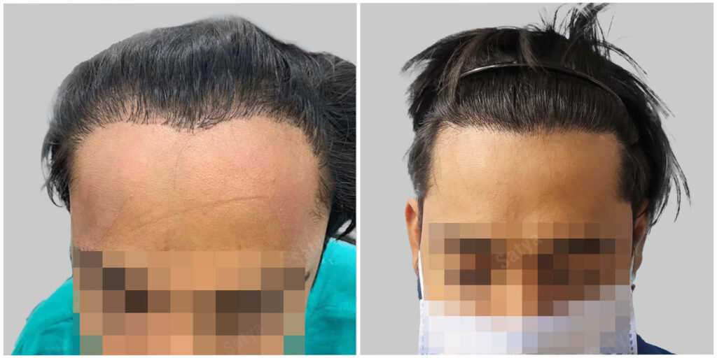repair hair transplant