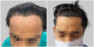 repair hair transplant