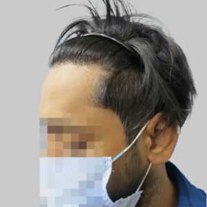 repair hair transplant