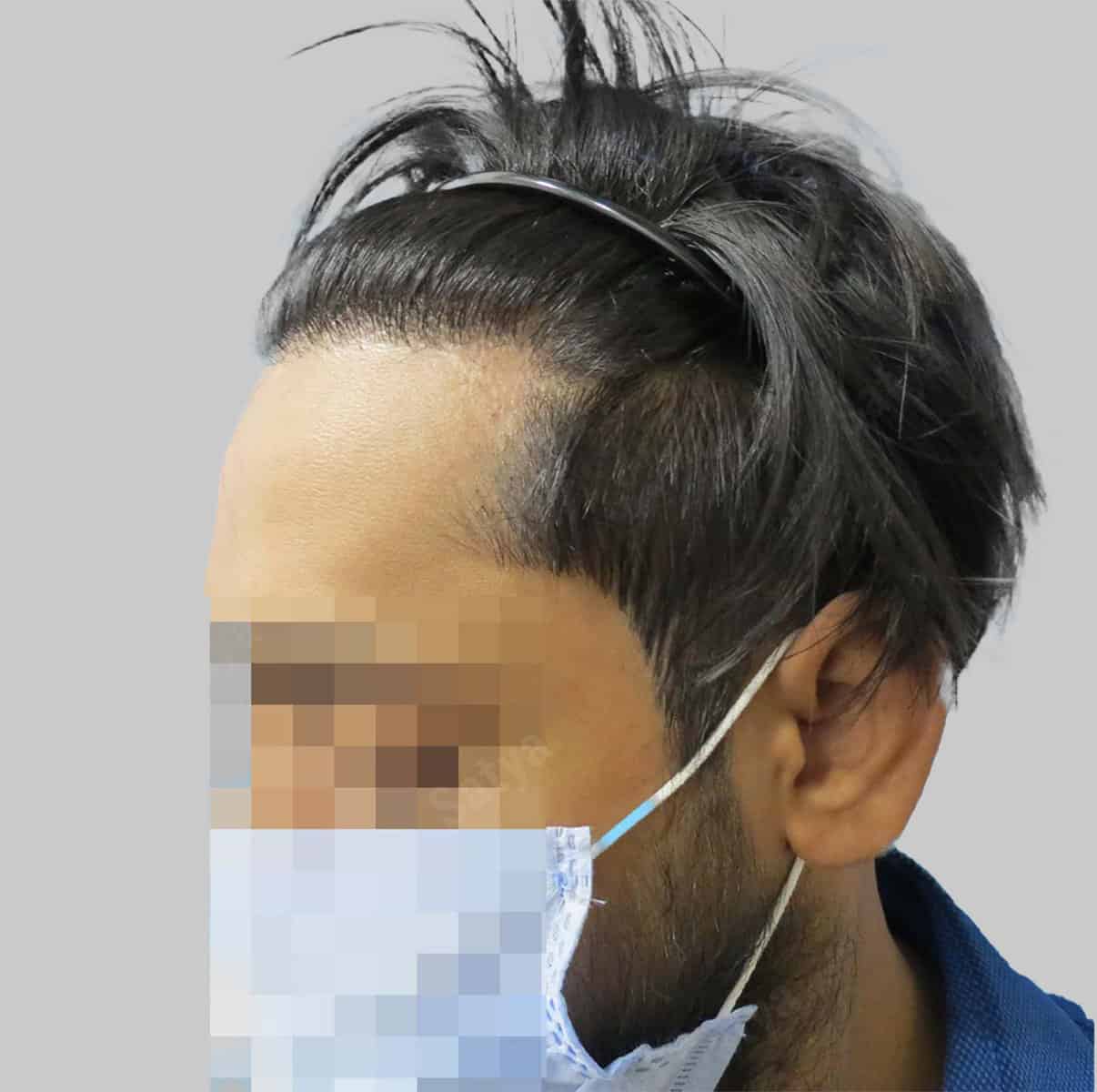 repair hair transplant