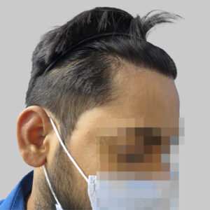 repair hair transplant