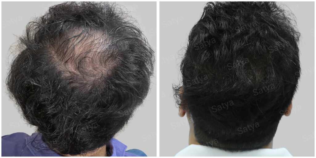 fue hair transplant