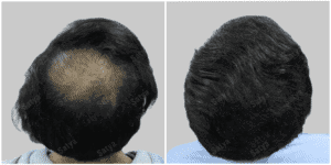 repair hair transplant