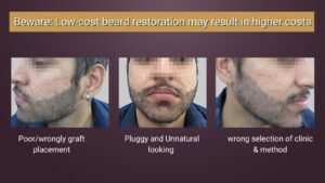 beard transplant