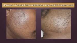 beard restoration