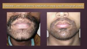 beard transplant
