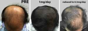 hair transplant in gurgaon