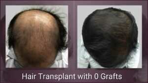 Zero graft transplant