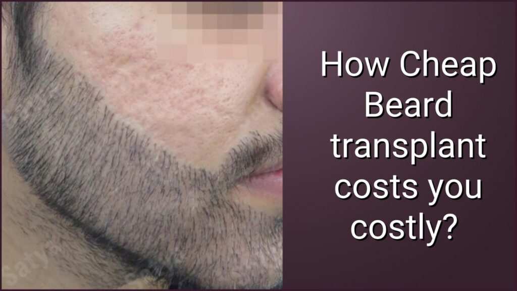 beard hair transplant