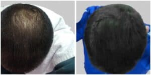 hair transplant in gurgaon