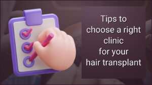 tips to choose right hair transplant clinic