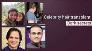 celebrity hair transplant