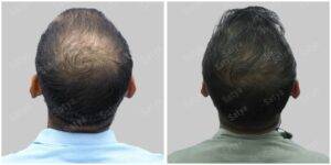 repair hair transplant