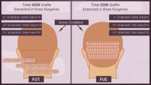 fue hair transplant