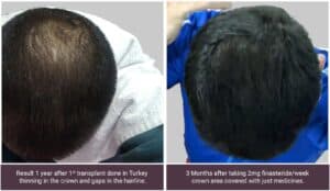 hair transplant in delhi