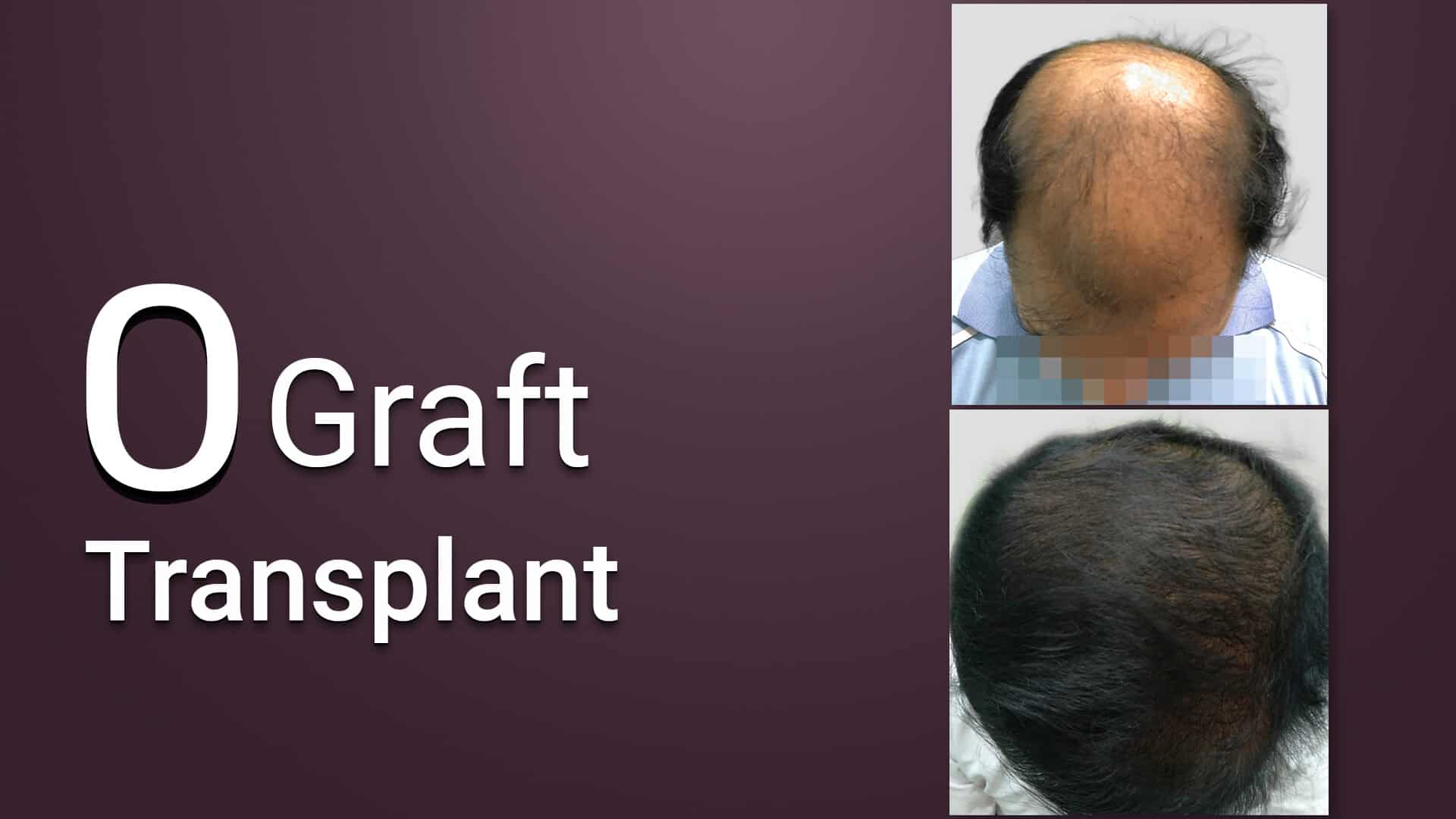 hair transplant