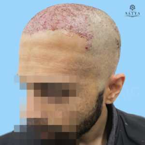 synthetic hair implant