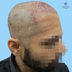 synthetic hair implant