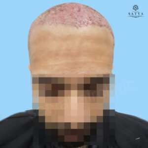 synthetic hair implant