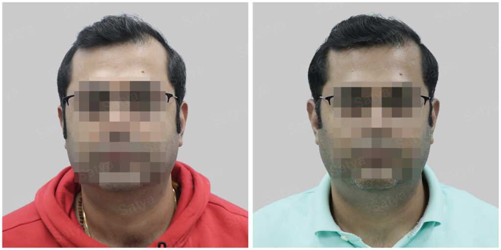 synthetic hair implant in delhi