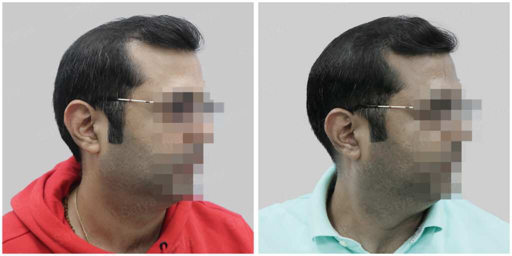synthetic hair implant in delhi