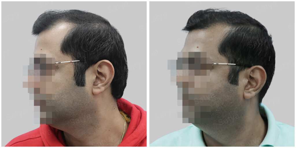 synthetic hair implant in delhi