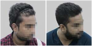 synthetic hair implant in delhi