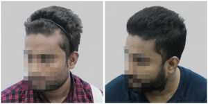 synthetic hair implant in delhi