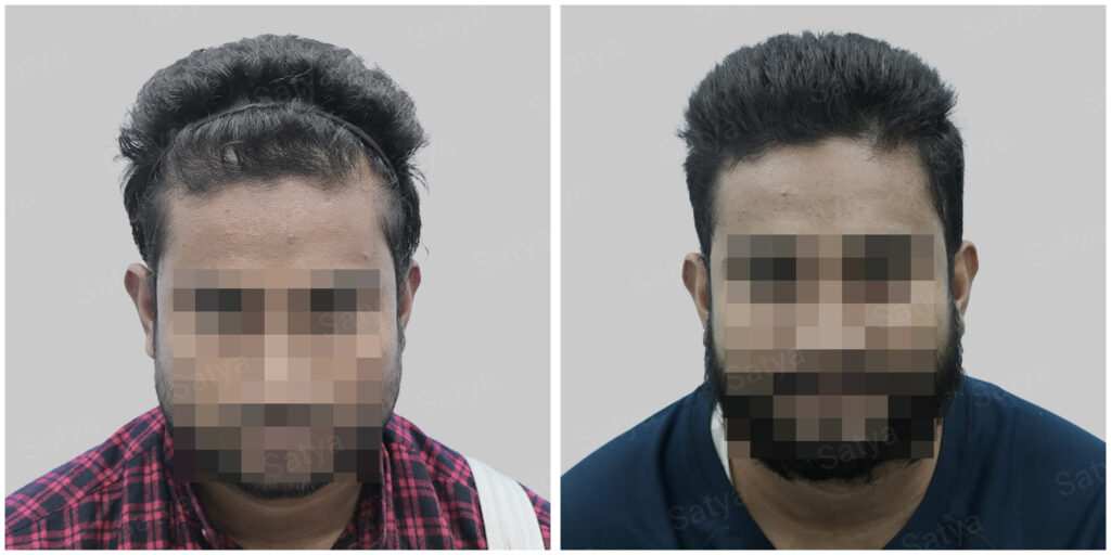 synthetic hair implant in delhi