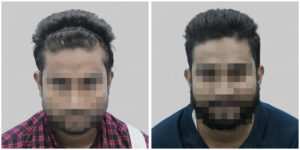 synthetic hair implant in delhi