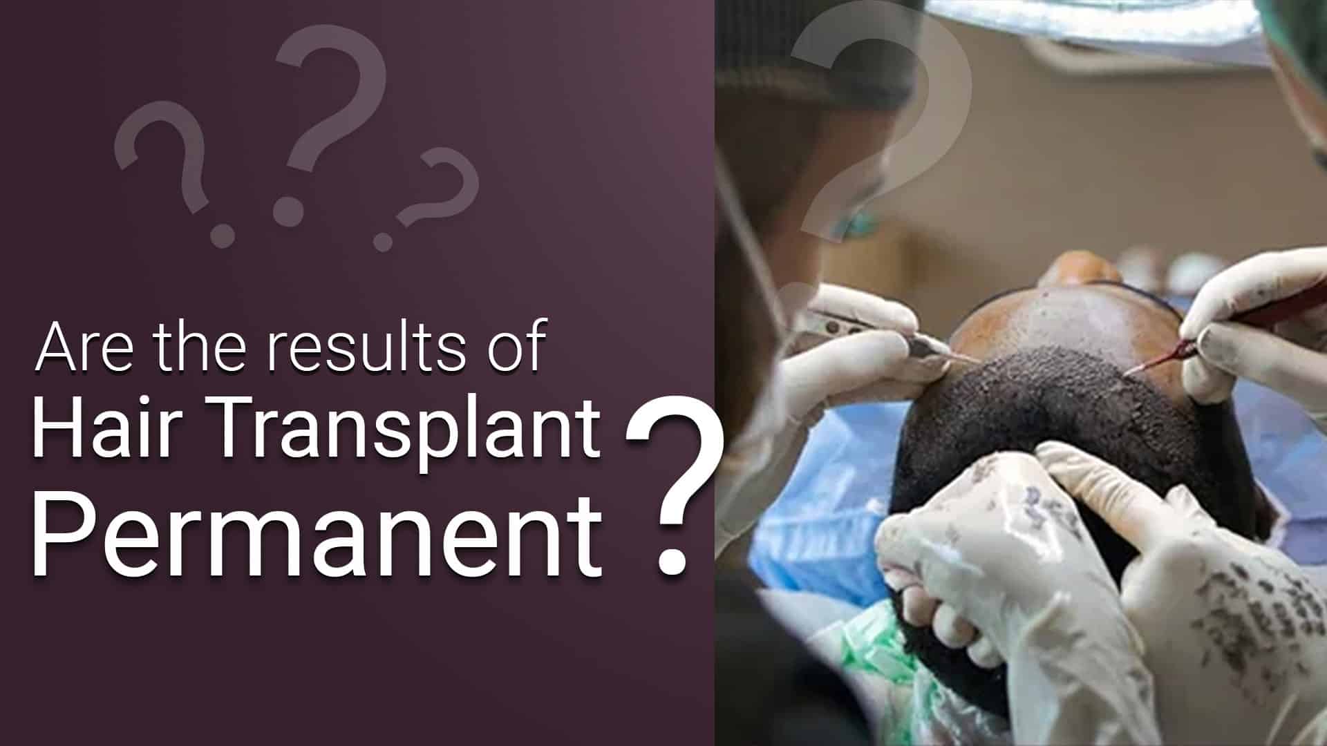 permanent hair transplant