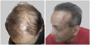 repair hair transplant