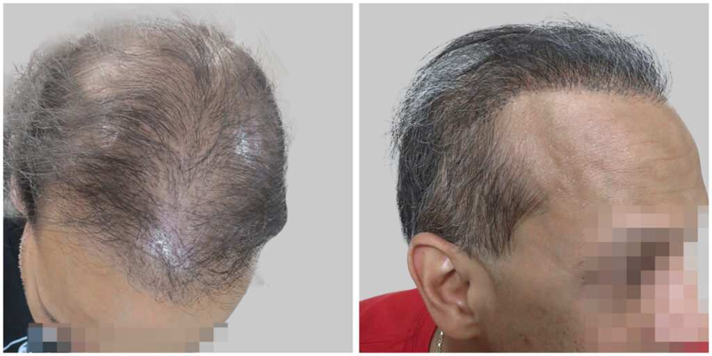 repair hair transplant