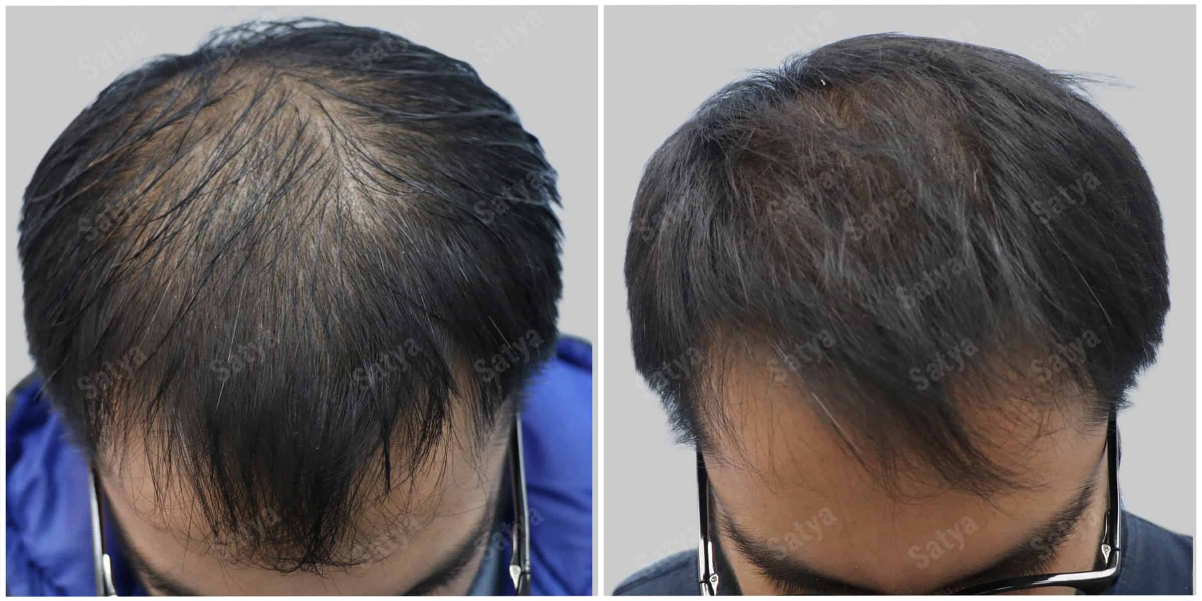 repair hair transplant