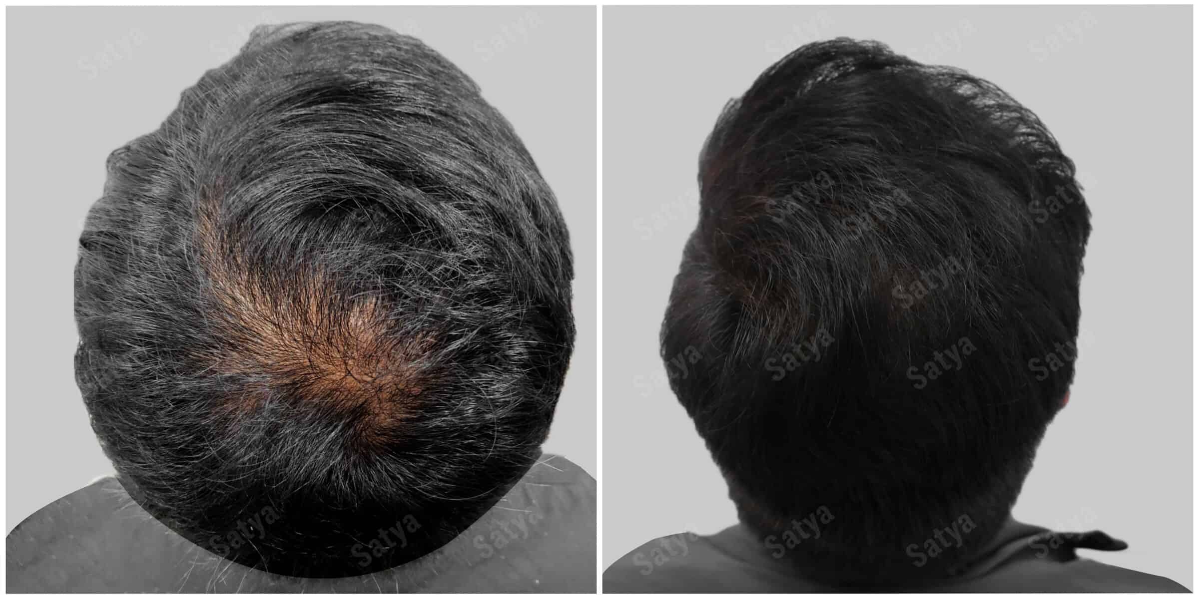 repair hair transplant