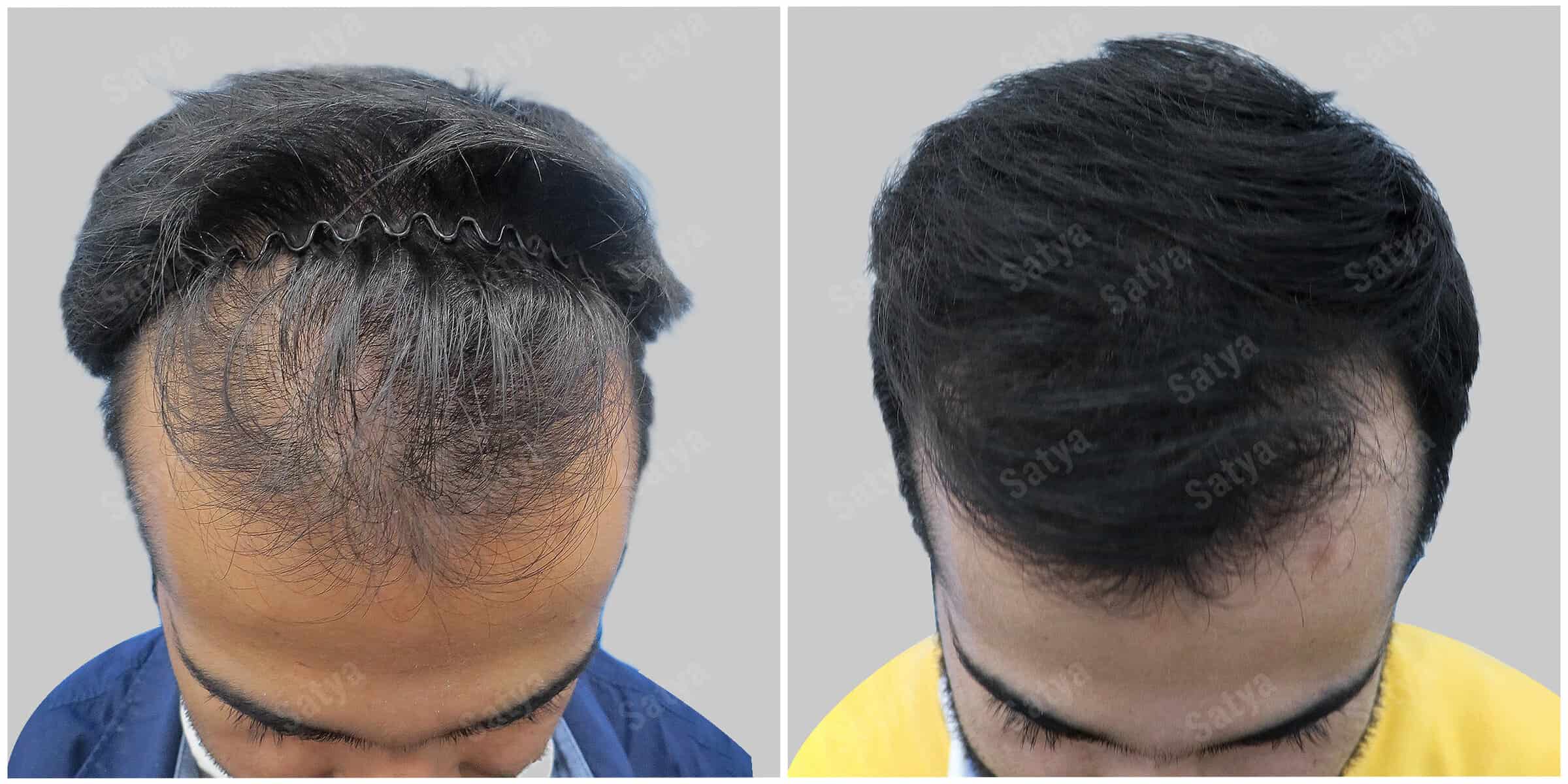 repair hair transplant
