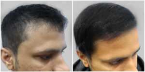 fue hair transplant