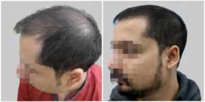 fue hair transplant