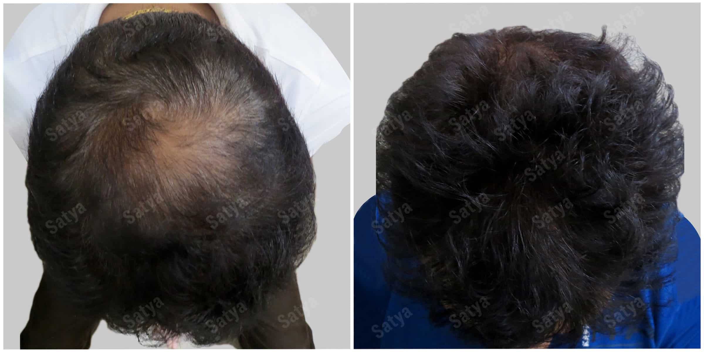 repair hair transplant