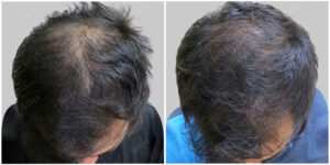 fue hair transplant