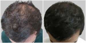 fue hair transplant