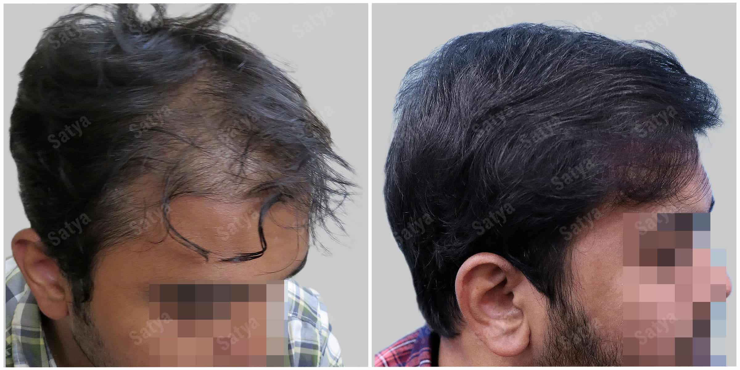 repair hair transplant
