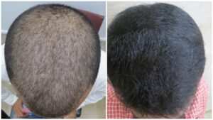 fue hair transplant