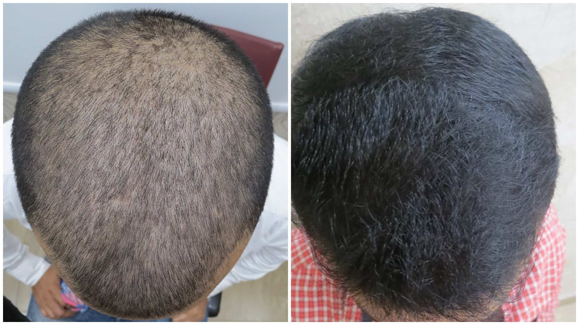 repair hair transplant