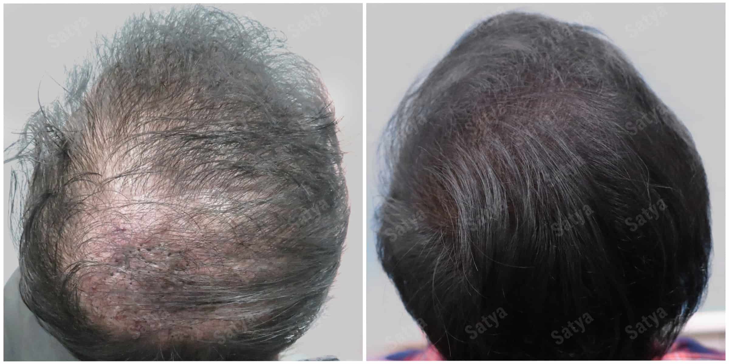 repair hair transplant