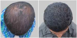 fue hair transplant