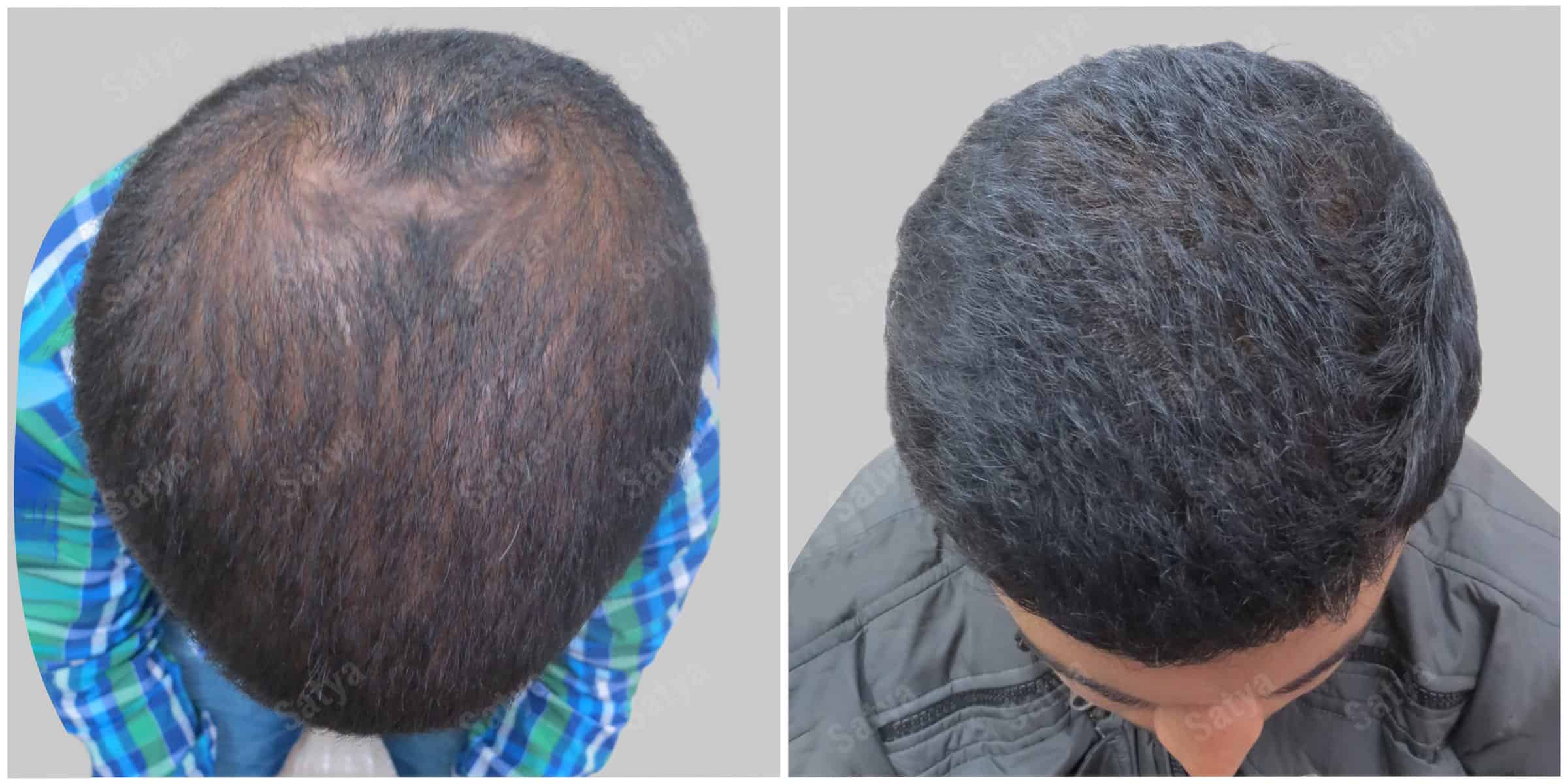 repair hair transplant