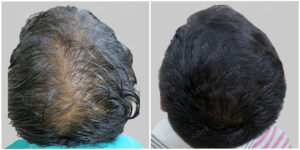 fue hair transplant