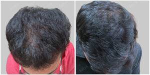 fut hair transplant